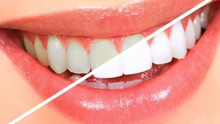 swords-dental-teeth-whitening
